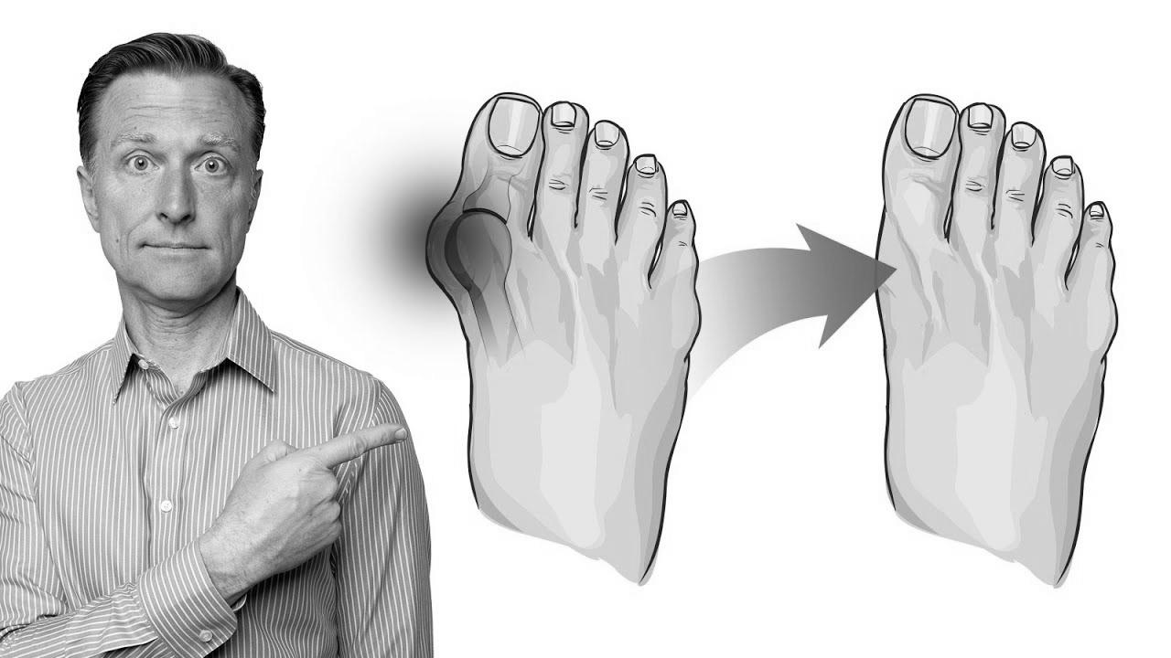 Find out how to Repair Bunions in 3 Steps